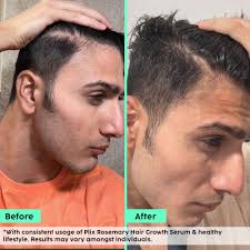 Rosemary Hair Growth Serum (Reduces Hair Fall & Promotes Hair Growth)